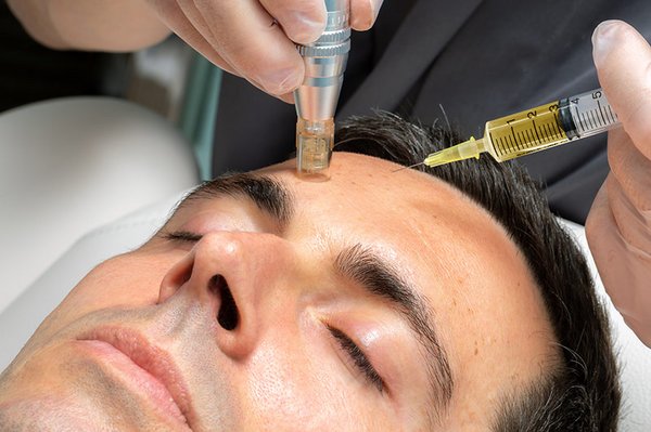 Microneedling und Mesotherapie