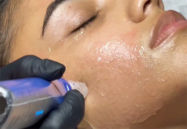 Skinpen Anwendung